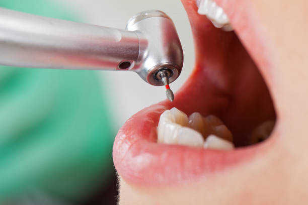 Best Emergency Treatment for Dental Infections or Abscesses in Fort Polk South, LA
